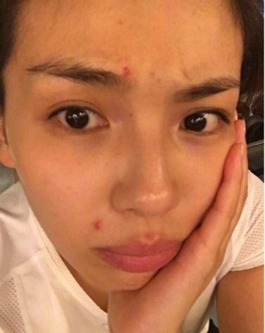 明星痘痘脸,护肤秘籍与美丽逆袭之路